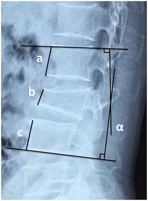 Short-segment fixation and transpedicular bone grafting for the treatment of thoracolumbar spine fracture